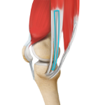 ACL Reconstruction Procedure of Hamstring Tendon