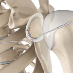 Arthroscopic Bankart Repair