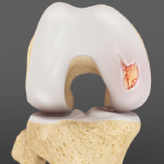 Chondral or Articular Cartilage Defects