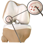 Chondroplasty