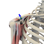 Distal Clavicle Excision