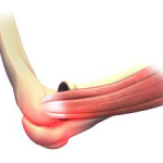 Elbow Sprain