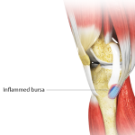 Goosefoot Bursitis of the Knee