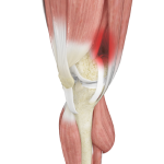 Iliotibial Band Syndrome