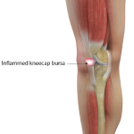 Kneecap Bursitis