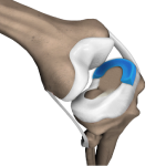 Meniscal Transplantation