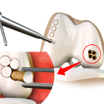 Mosaicplasty