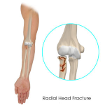 Radial Head Fractures of the Elbow