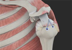 Rotator Cuff Repair