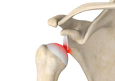 Labral Repair/Shoulder Stabilization